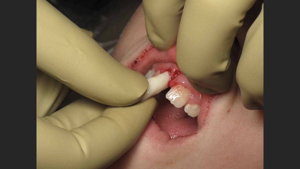 A knocked-out or broken tooth: what to do in the first hour