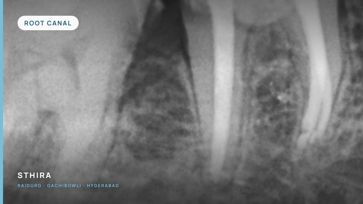 Why a root-treated tooth usually needs a crown