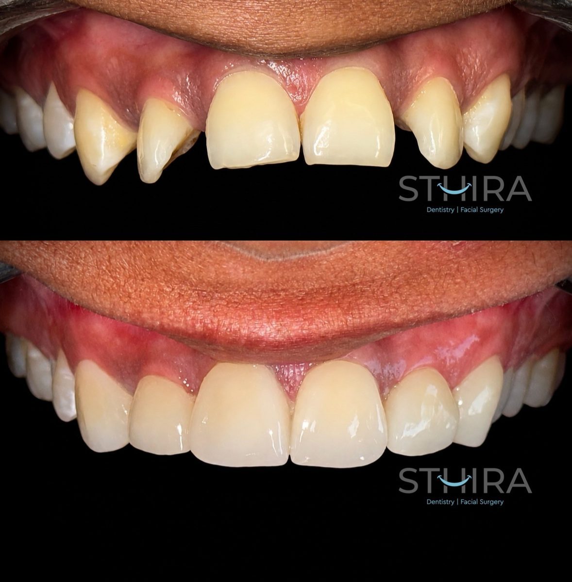 Smile Design & Makeover at STHIRA, Raidurg