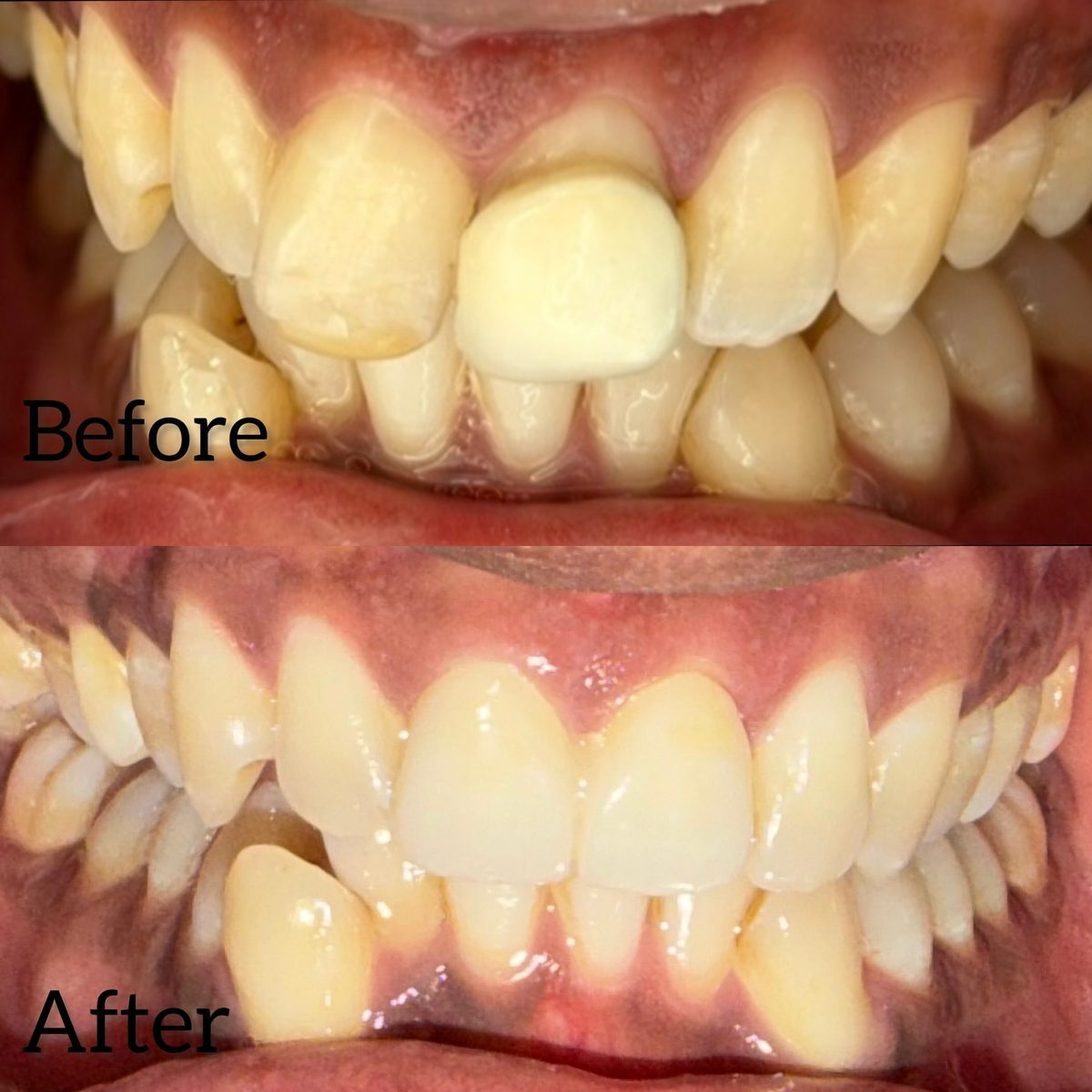 Veneers at STHIRA, Raidurg